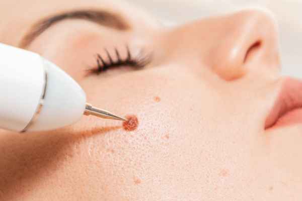 CryoPen: 5 Skin Concerns It May Be Used to Treat 3 What actually happens during a CryoPen treatment Groby?