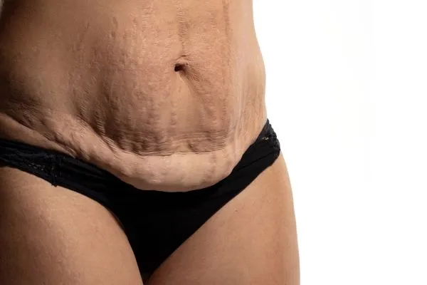 Lost the Weight but Not the Loose Skin? 1 image of womans stomach after weight loss showing loose skin Groby